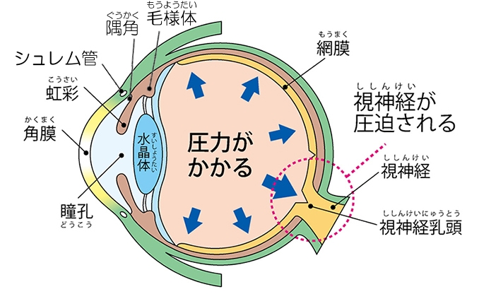 緑内障について